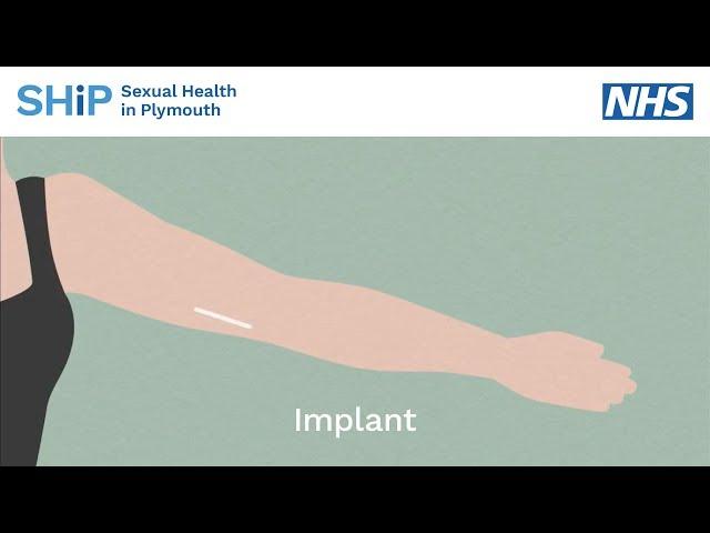 Having a contraceptive implant fitted