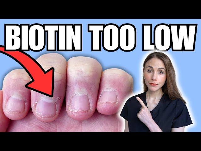 8 Biotin Deficiency Warning Signs NOT TO MISS | Hair, Skin, & Nails