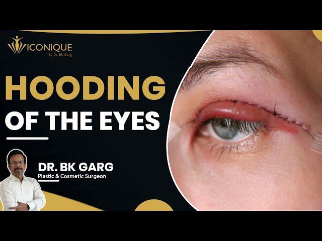 Hooded Eyelids Treatment | Hooded Eyelid Fix | Hooded Eyelids Exercise | Hooded Eyes Treatment