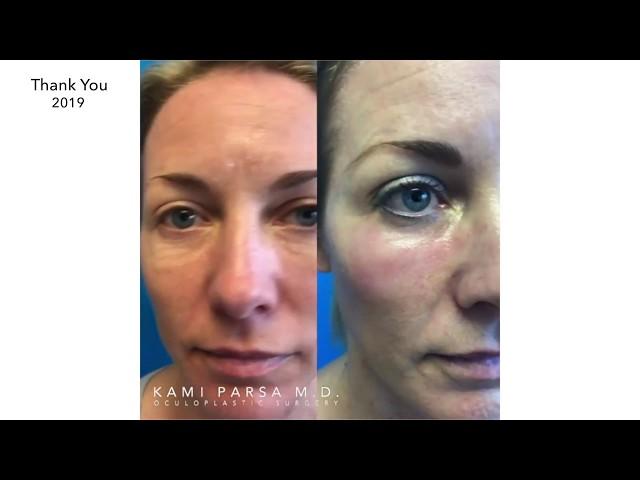Before & Afters of Patients | Kami Parsa, M.D.