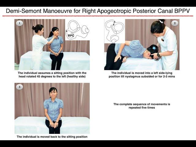 Demi-Semont Manoeuvre for Right Apogeotropic Posterior Canal BPPV