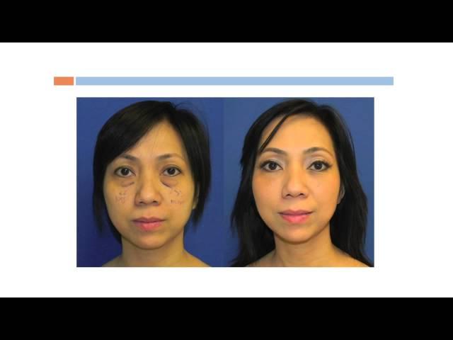 Upper and Lower Eyelid Lift, Blepharoplasty, Washingtonian Plastic Surgery Dr. Navin Singh