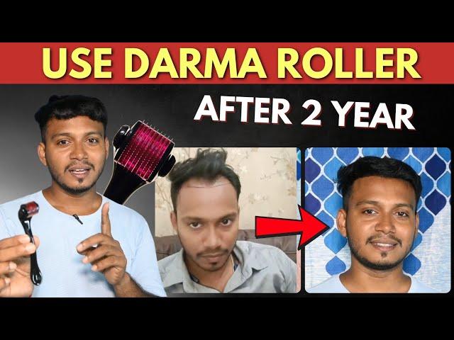 DermaRoller Effects After 2 YEAR Hair Transplant