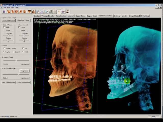 11   Superimposing two volumes  InVivoDental Training Videos