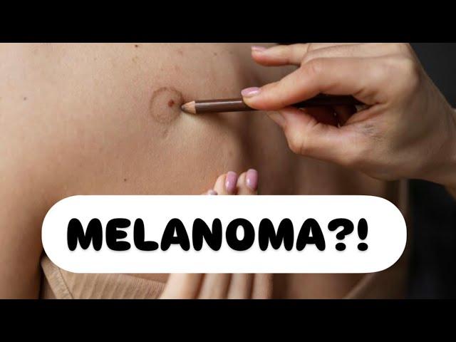 Shenjat paralajmëruese të melanomës: Çfarë duhet të keni kujdes