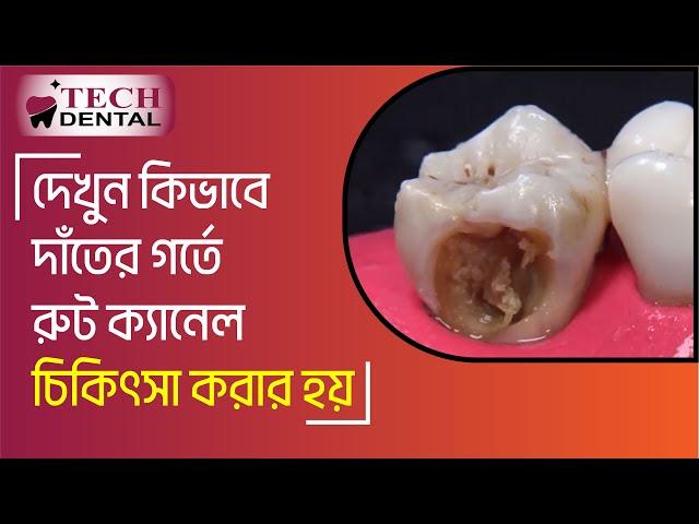 দেখুন কিভাবে দাঁতের গর্তে রুট ক্যানেল চিকিৎসা করা হয় । Root Canal Treatment procedure । Tech Dental