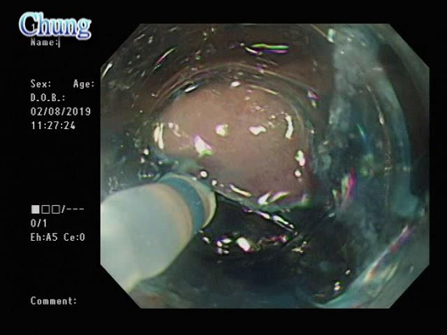 ESD for early gastric cancer