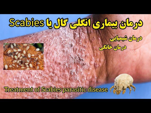 انواع روش‌های درمان بیماری #انگلی #گال، شیمیایی، گیاهی، خانگی Treatment of Scabies parasitic disease