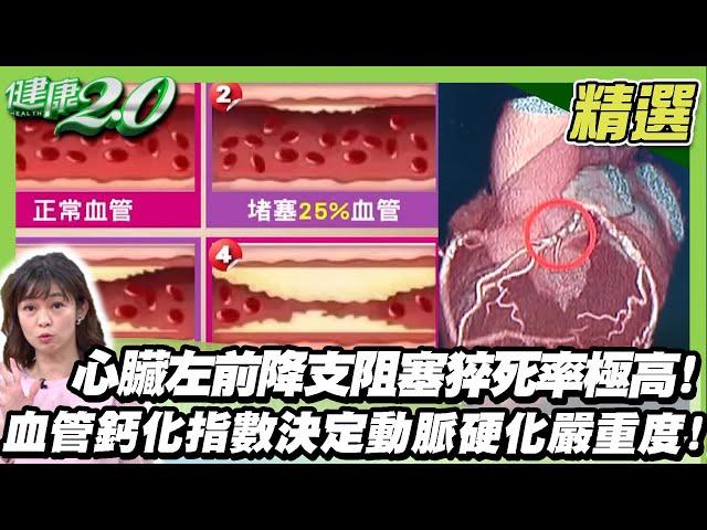 心臟左前降支阻塞猝死率極高！中風徵兆？血管鈣化指數決定動脈硬化嚴重度！【健康2.0精選】