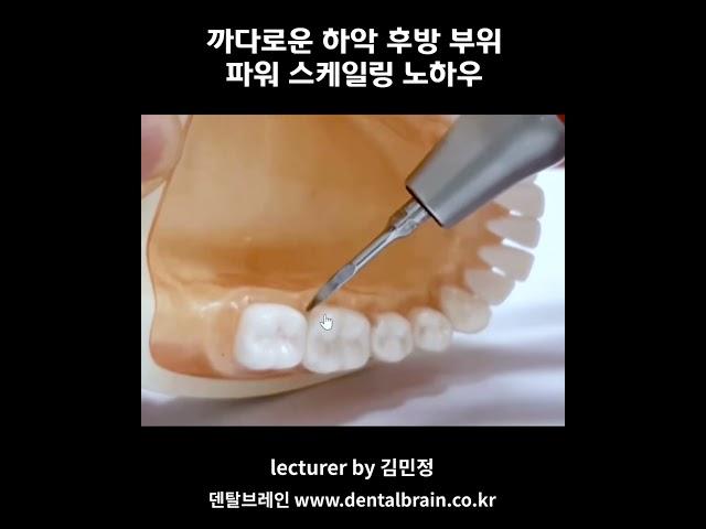 MJTV(엠제이티비) 까다로운 하악 후방 부위 파워 스케일링 노하우