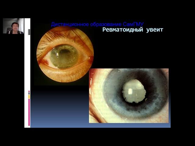 Болезни сосудистой оболочки глаза Часть 1