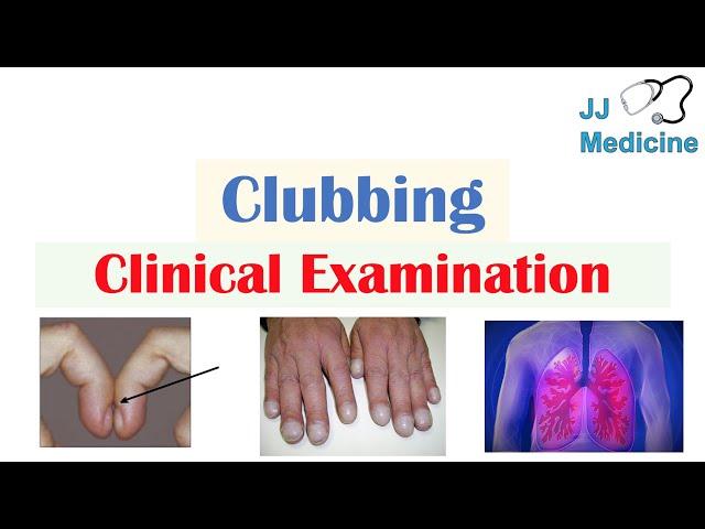 Clubbing (Fingers & Toes) | Causes, Schamroth’s Sign, Associated Conditions, Treatment