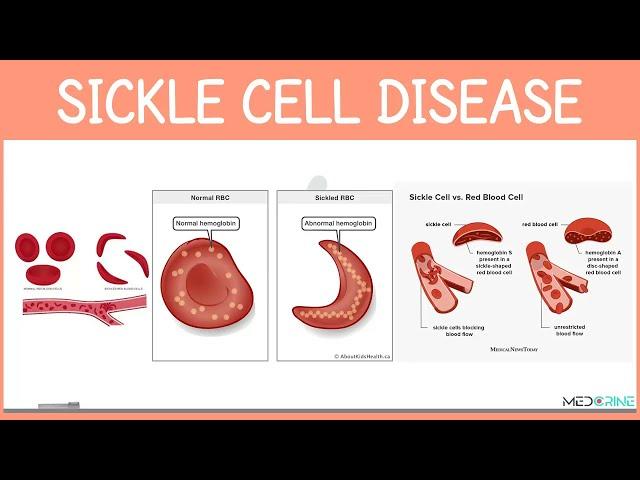 Sickle cell Disease Simplified