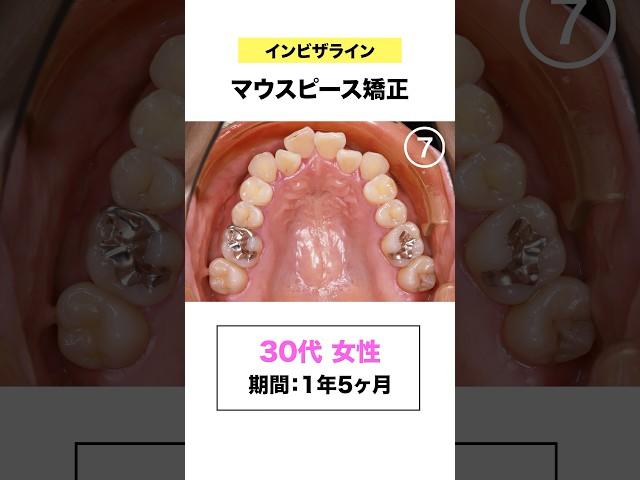 ワイヤーではなくマウスピース矯正で治したい方必見 #shorts #歯列矯正 #マウスピース矯正 #インビザライン