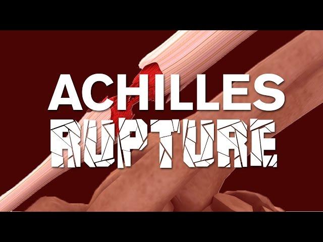 What happens when an achilles tendon ruptures?