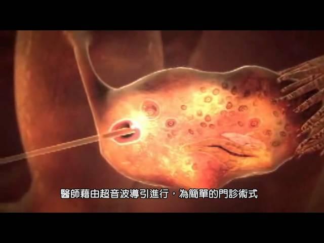 試管嬰兒 (IVF) : 認識試管嬰兒、試管嬰兒流程