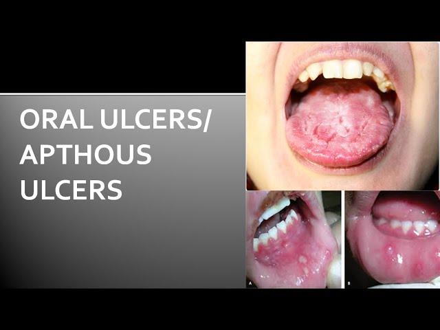 Oral Ulcers | How To Get Rid Of Oral Ulcers | Oral Ulcer Treatment