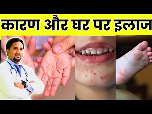 बच्चों के हाथ पैरों मुँह पर निकलने वाले दाने Hand foot mouth disease