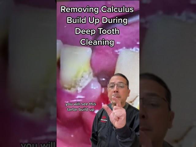 Deep Tooth Cleaning to Remove Calculus with Ultrasonic Scaler| In Office to Hands On Dental Training