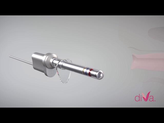 diVa Laser Vaginal Therapy: Offered at Capizzi MD Cosmetic Surgery & Med Spa