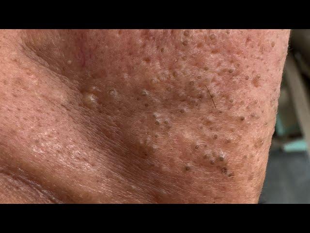 Big pimple removal