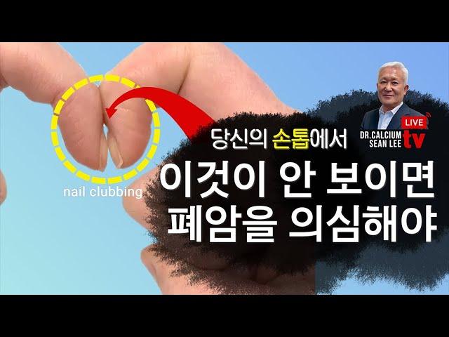 [Dr. Calcium SEAN LEE TV 제 1038회] 당시 손톱에서 이것이 안 보이면 폐암을 의심해야 할 수도 2022. 10. 31 라이브 (생방송)