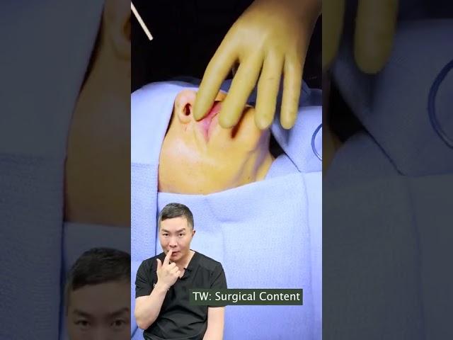 Removing Silicone Lip Filler with Dr. Young Cho at Integrated Aesthetics