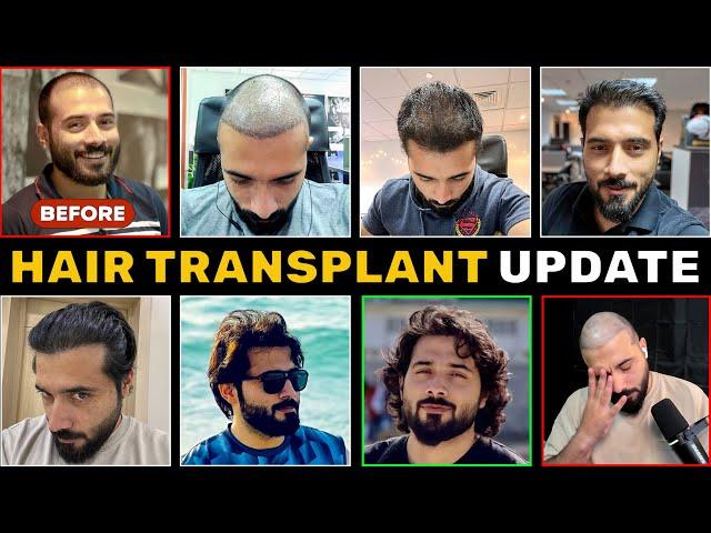 My Hair Transplant After 3 Years Update | Turkey vs Pakistan | Before and After Photos