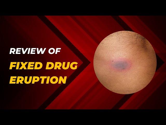 A review of fixed drug eruption