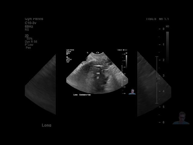 IUD Malposition #meded #doctor #medicalschool