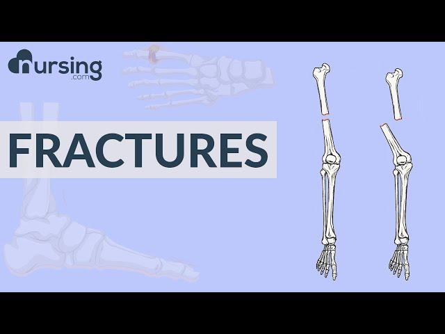 Fractures Nursing Care