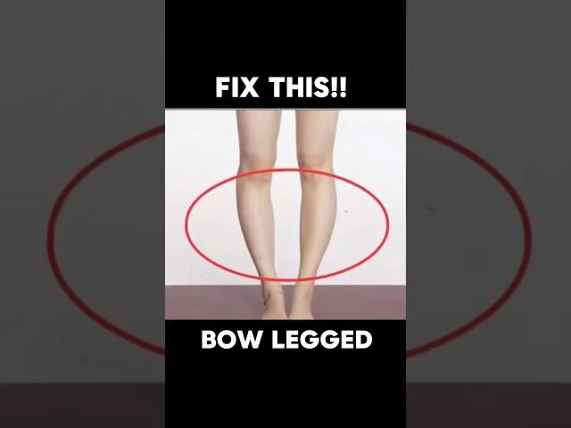Exercise for BOW LEGGED  #bowlegs #shortsfeed #shortsvideo