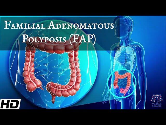 Familial Adenomatous Polyposis ( FAP): Everything You Need To Know