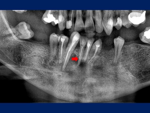 Management of root resorption