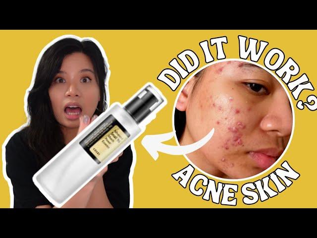 1 YEAR OF COSRX ADVANCED SNAIL MUCIN POWER ESSENCE HONEST REVIEW | ACNE SKINCARE | sensitive skin