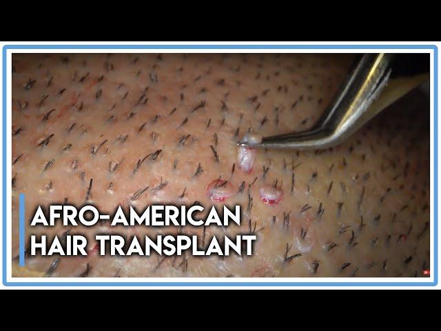 Afro-American Hair Transplant Follicular Unit Extraction [Maximum Zoom!]