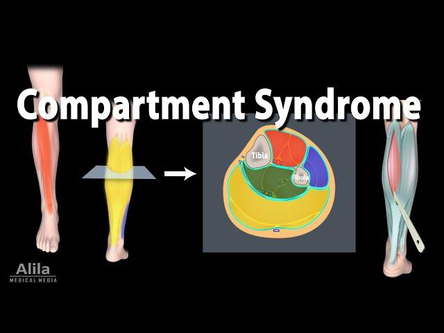 Compartment Syndrome, Animation