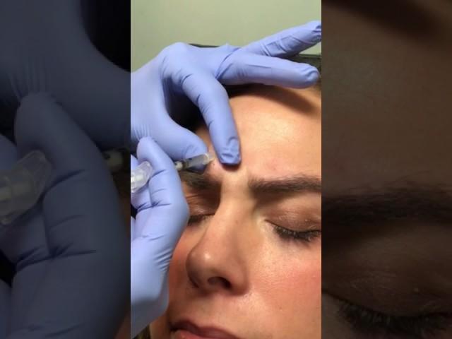 Seriously Skin Botox Treatment for Angry Lines Glabellar Lines