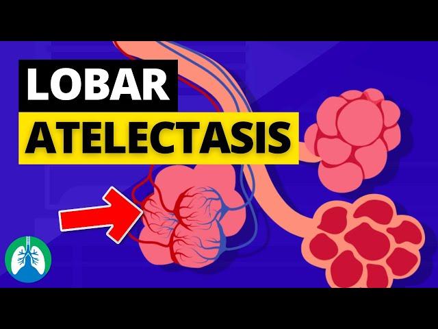 Lobar Atelectasis (Medical Definition) | Quick Explainer Video