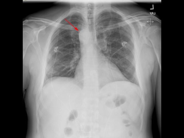 Right Aortic Arch