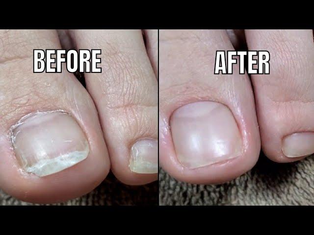 美甲教學2021 | 慎入！嵌甲處理大公開，清理過程超療癒 Pedicure/Ingrown Toenail