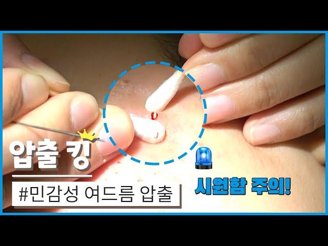 [압출킹] 05. 민감성 여드름 압출 ASMR 시원함 주의!!!