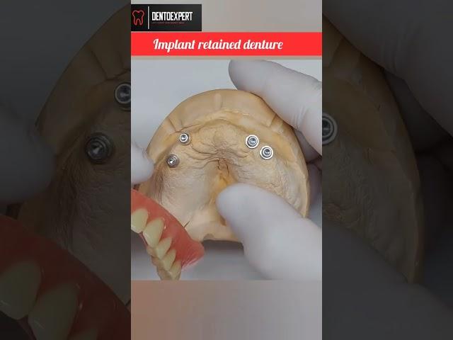 4 Implant Retained Overdenture | Osstem Implant Retained Denture#shorts #dentist #viral #osstem