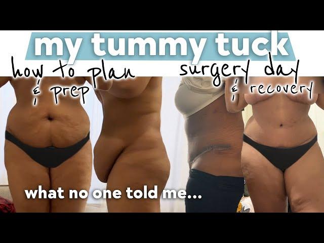 What I Wish I Knew Before Getting A Tummy Tuck (full abdominoplasty)