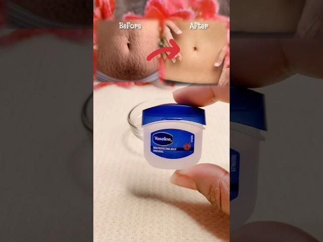 Stretch Marks Removal Cream at Home  #viral #stretchmarks #skincare #stretchmarkscream #shorts