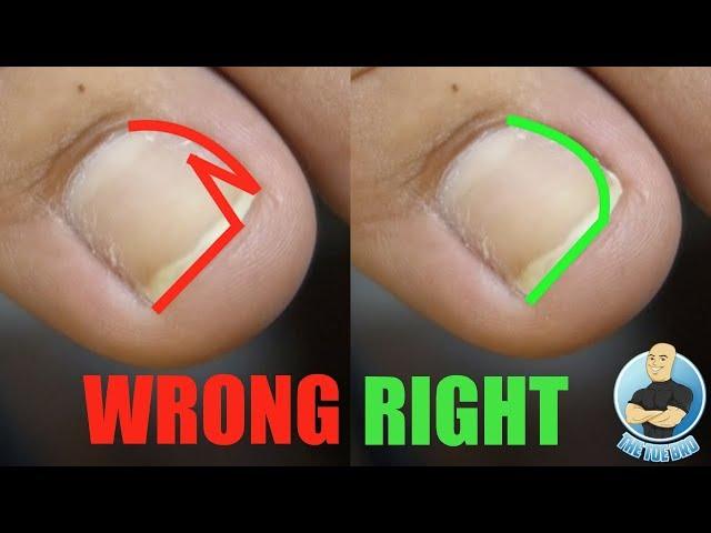 EASY DIY AT HOME TREATMENT FOR INGROWN TOENAILS USING INGROWN TOENAIL TOOL