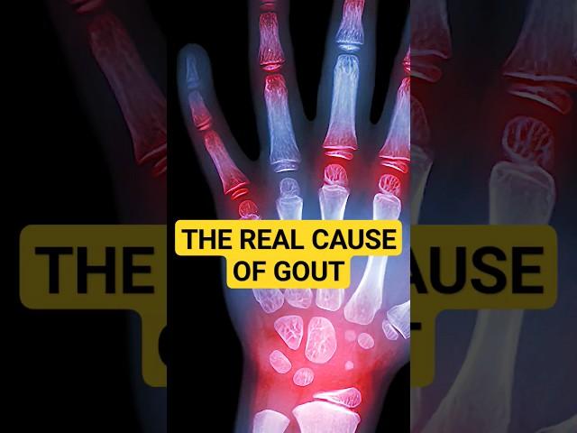 Here's Why You Have GOUT, And How To Fix It!   #gout