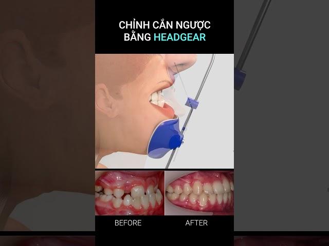 Chỉnh răng cắn ngược bằng khí cụ Facemask #braces #orthodontics