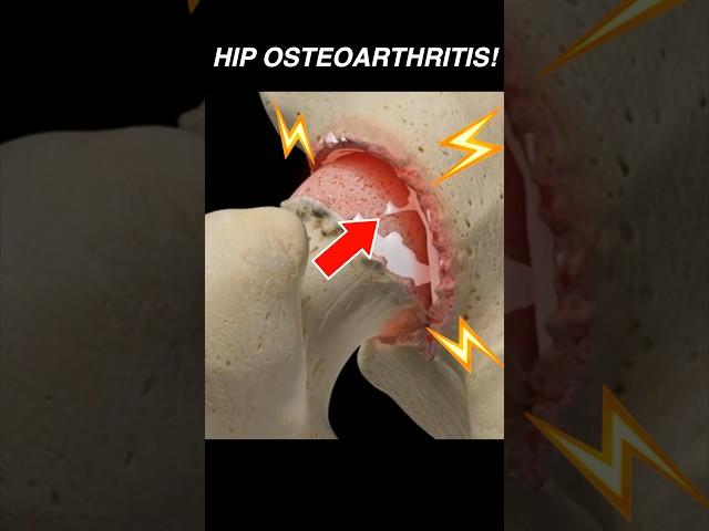 Doctor Explains: Hip OSTEOARTHRITIS 