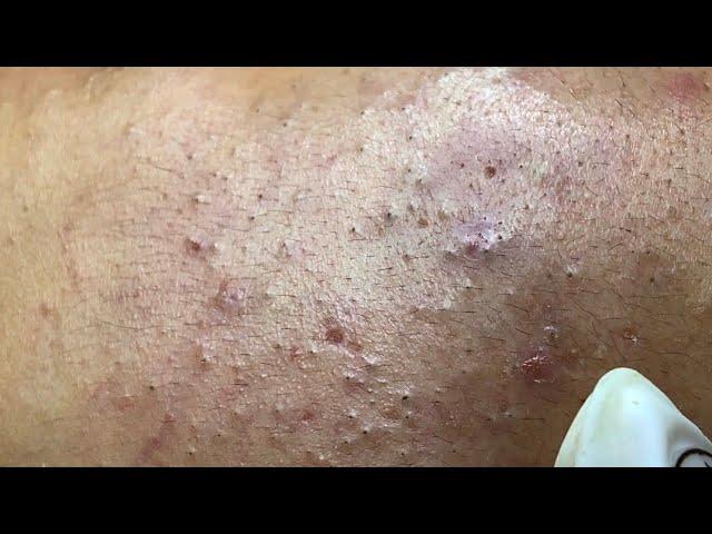 The best acne squeezing collection form Linh Mun Spa part 14